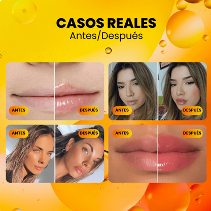 1+1 GRATIS | Voluminizador de Labios con Vitamina E - Derol™ Kit